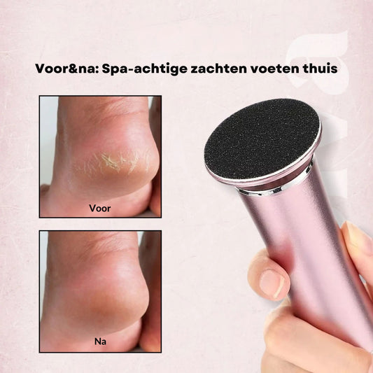 ZachteVoeten™ Electric Callus Remover| Get Beautiful Natural Feet In 7 Days